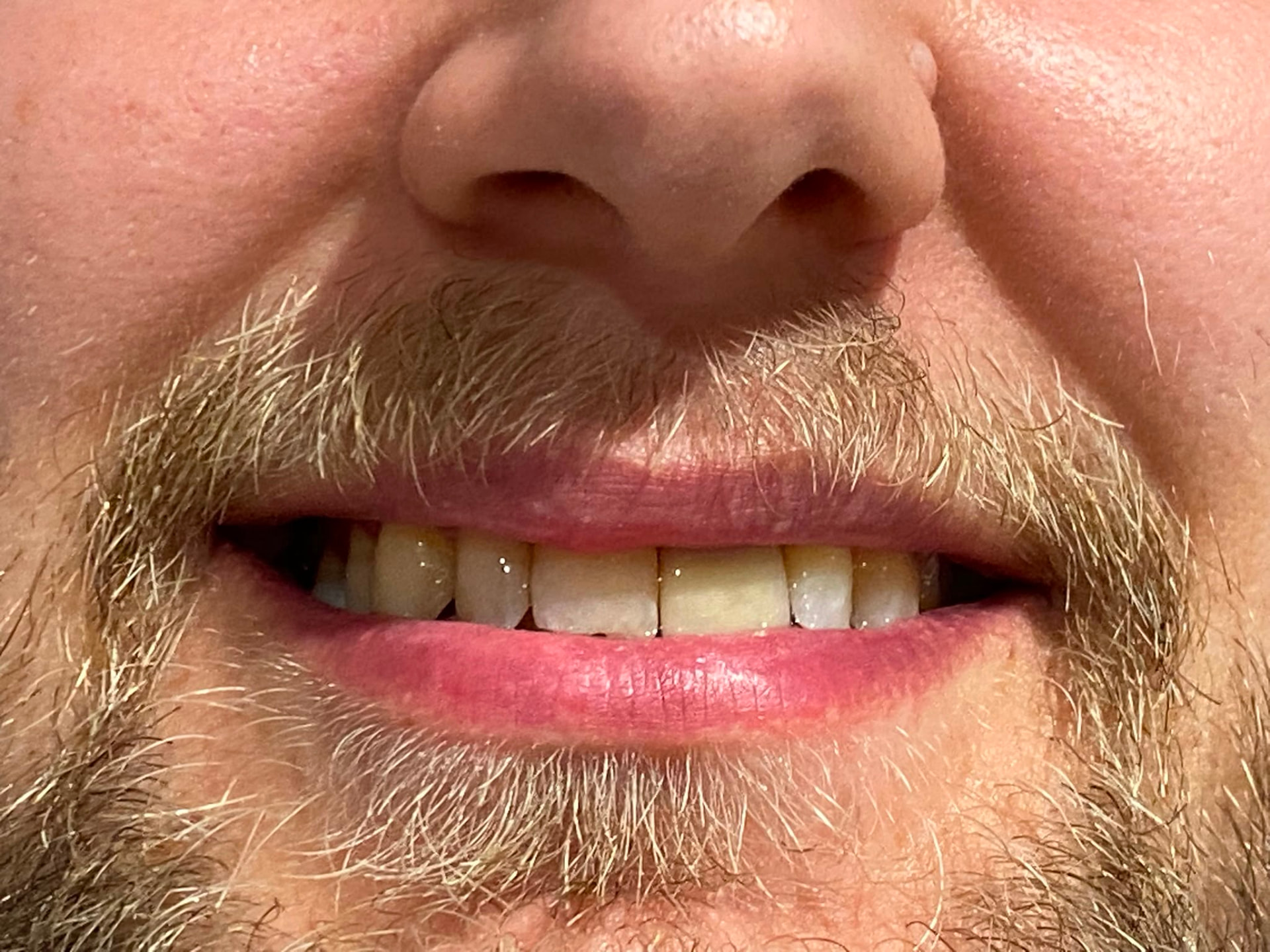 Single Upper Left Central Incisor Implant — after same-day fixed teeth at Staplehurst Dental Practice