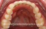 Dental after image showing the upper teeth
