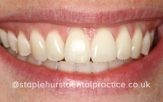 A close-up photograph of a person's smile after dental treatment