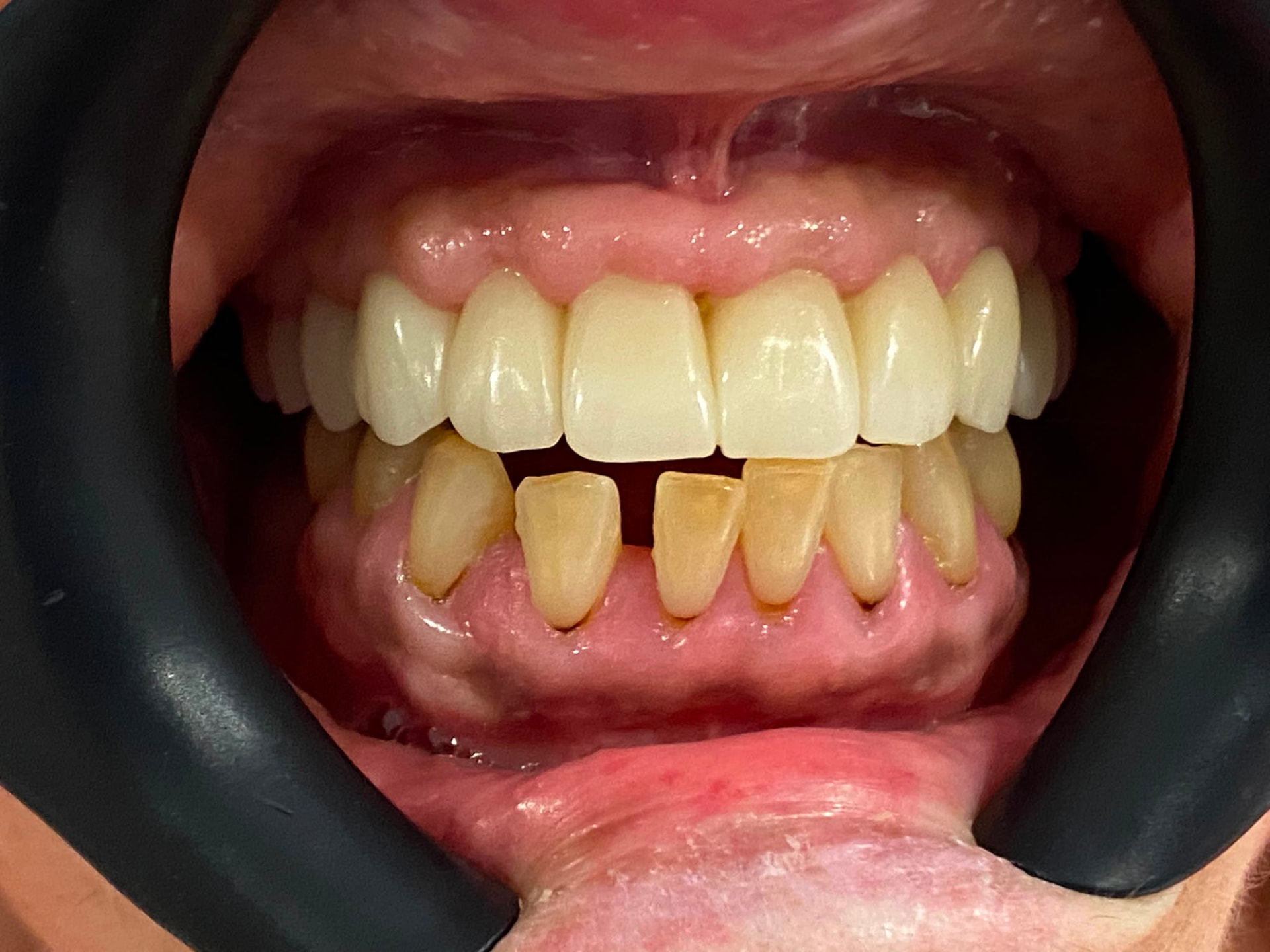 All on 6 implant placement — after same-day fixed teeth at Staplehurst Dental Practice