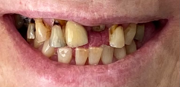 Upper full arch — before full-arch dental implant treatment