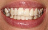 A close-up of teeth before treatment