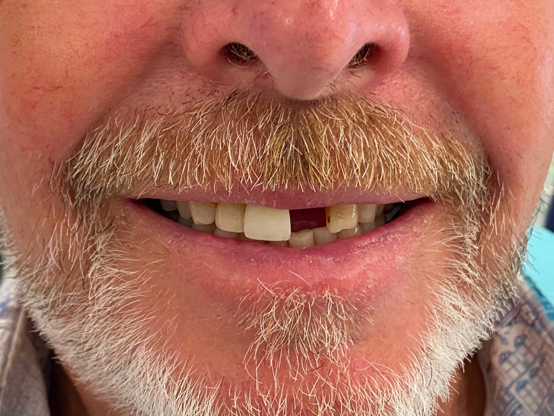 Single Implant Case, UL1 — before full-arch dental implant treatment