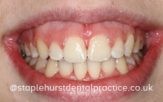 After treatment smile