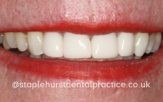 A close-up photograph of a person's smile after dental treatment