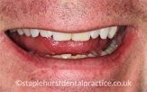 Close-up of a man's teeth before treatment