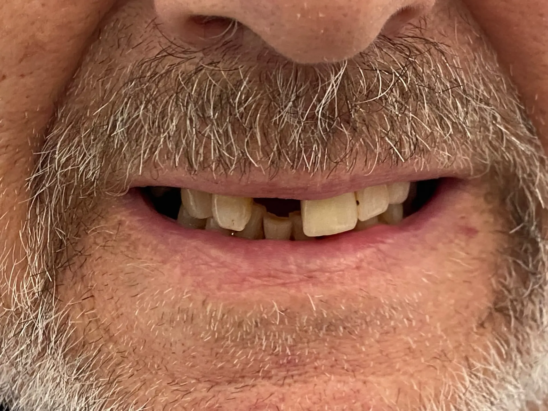 Failing upper teeth, All-on-4 — before full-arch dental implant treatment