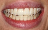 A close-up of teeth after treatment