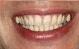 Close-up of teeth before treatment