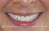 After treatment smile