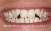 Close-up of a woman's teeth before treatment