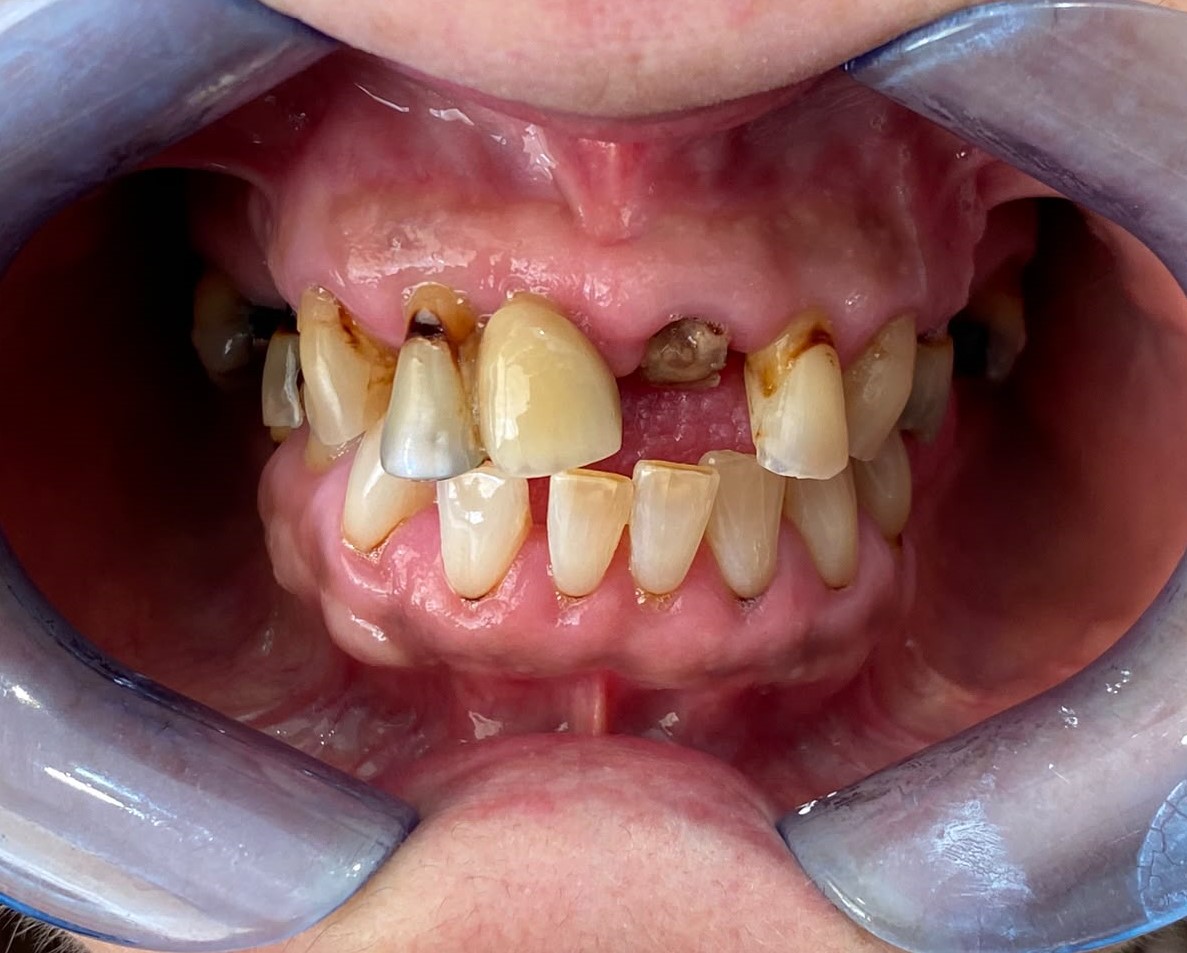 All on 6 implant placement — before full-arch dental implant treatment