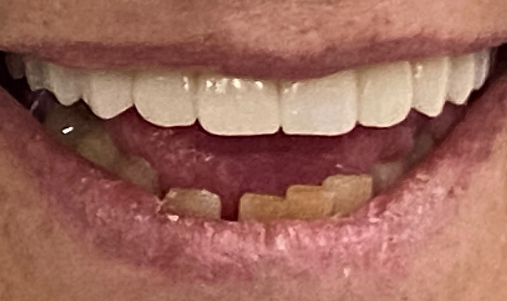 Upper full arch — after same-day fixed teeth at Staplehurst Dental Practice