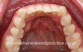 Dental before image showing the upper teeth