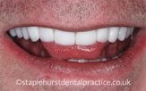 Close-up of a man's teeth after treatment