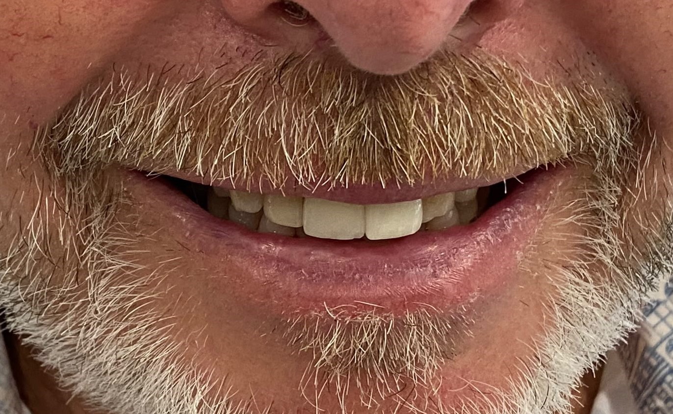 Single Implant Case, UL1 — after same-day fixed teeth at Staplehurst Dental Practice