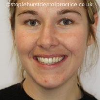 A woman smiling, showing her teeth