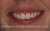 A close-up photograph of a person's teeth after dental treatment