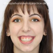 Patient smiling after treatment