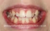 Before treatment smile
