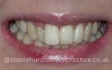Close-up of teeth before treatment