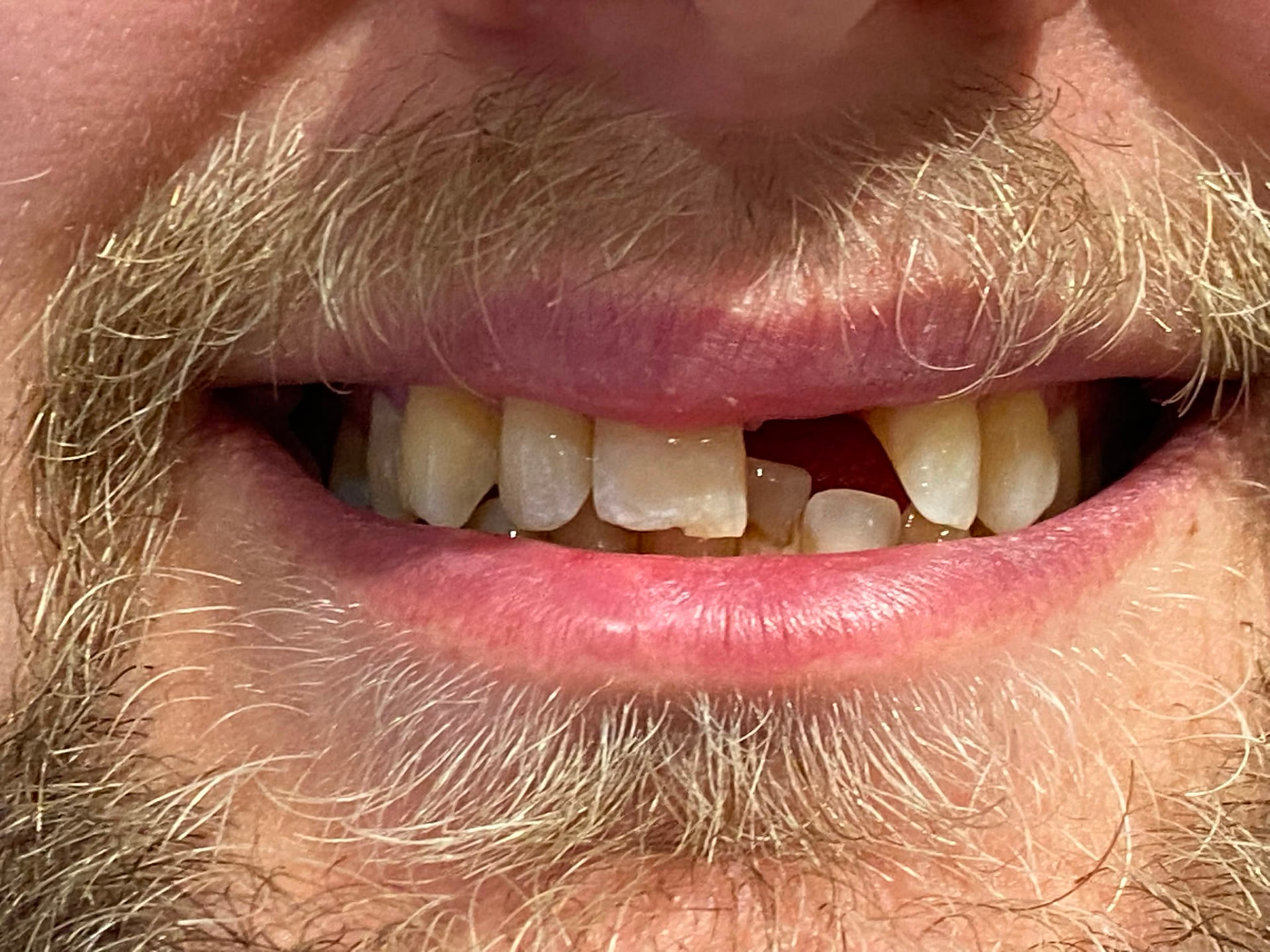 Single Upper Left Central Incisor Implant — before full-arch dental implant treatment