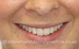 Before treatment smile