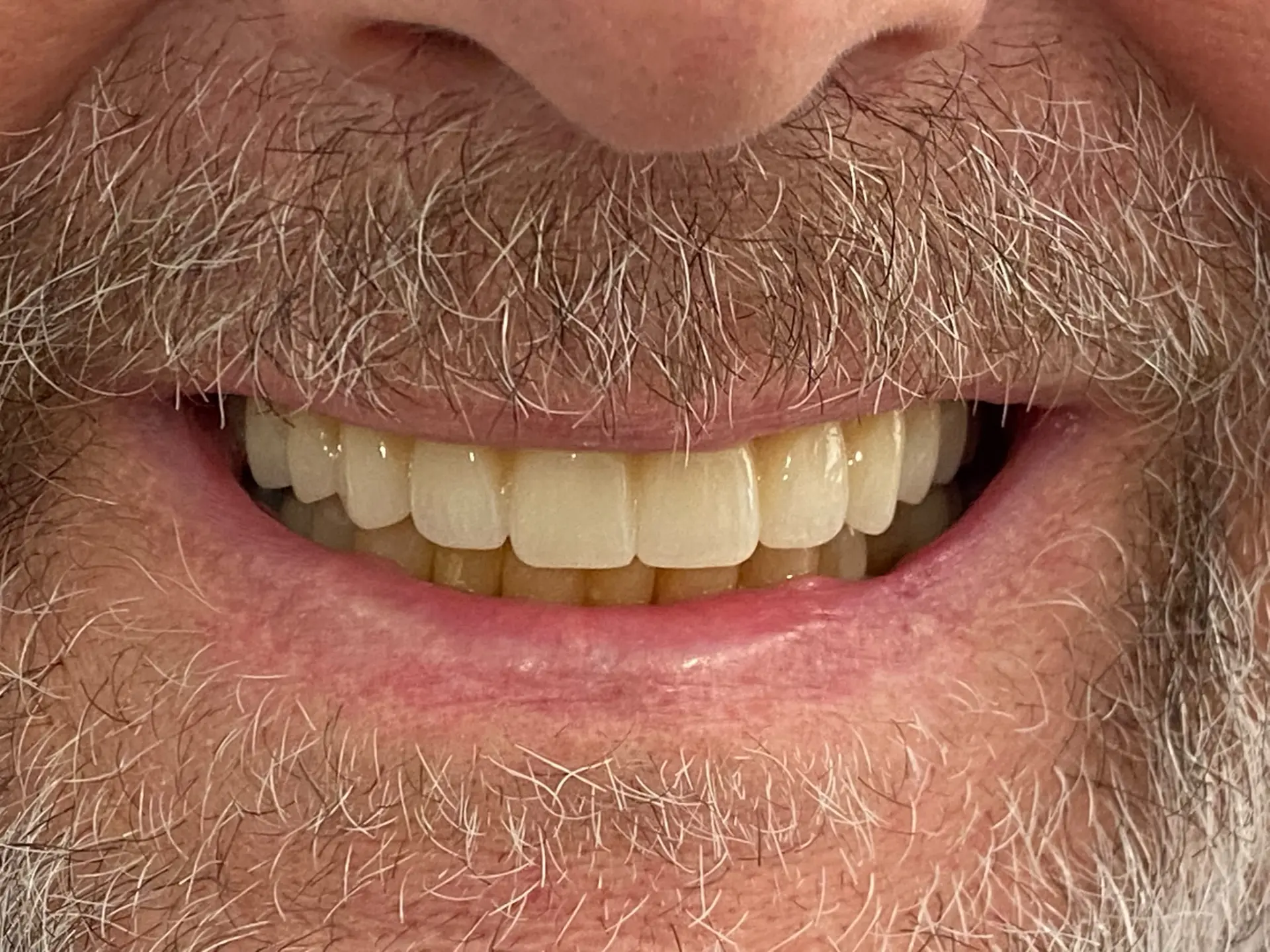Failing upper teeth, All-on-4 — after same-day fixed teeth at Staplehurst Dental Practice