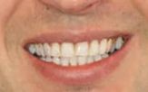 Close-up of teeth after treatment