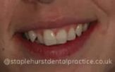 A close-up photograph of a person's teeth before dental treatment