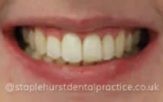 A close-up photograph of a person's smile showing teeth after treatment