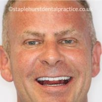 A man smiling, showing his teeth