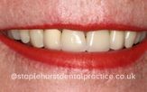 A close-up photograph of a person's smile before dental treatment